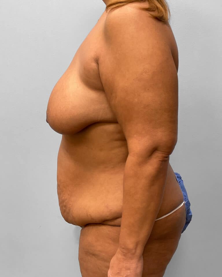 Before Image: Mommy Makeover- Dr. Howell - left-side