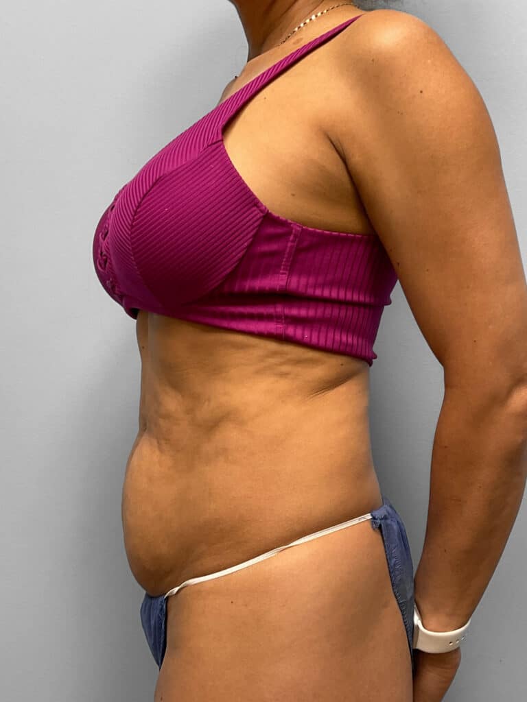 Before Image: Tummy Tuck & Lipo- Dr. Howell - left-side
