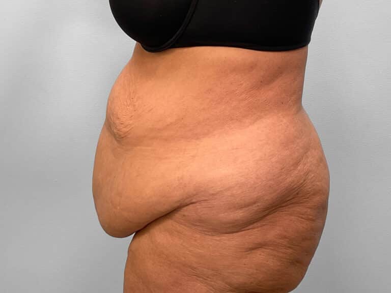 Before Image: Abdominoplasty, Lipo & Thigh Lift- Dr. Tucker - left-side