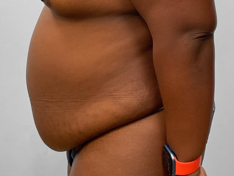 Before Image: Abdominoplasty & 360 Liposuction- Dr. Tucker - left-side