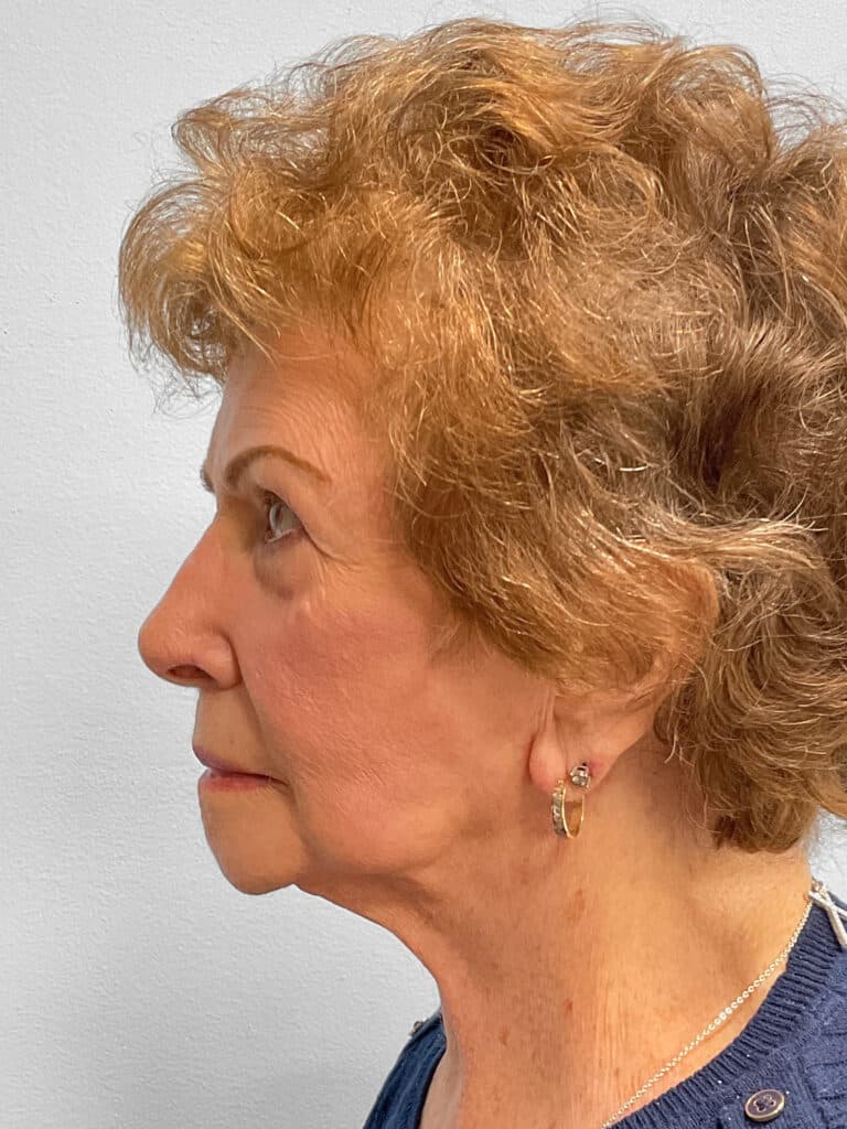 Before Image: Facelift- Dr. Tucker - left-side