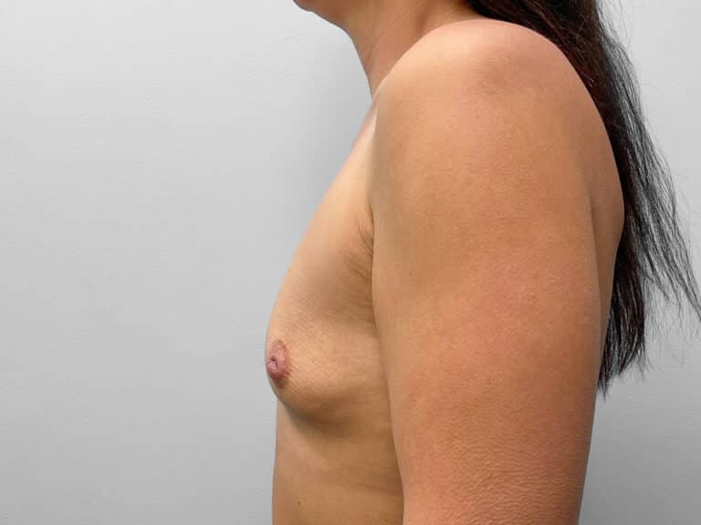 Before Image: Breast Augmentation- Dr. Tucker - left-side