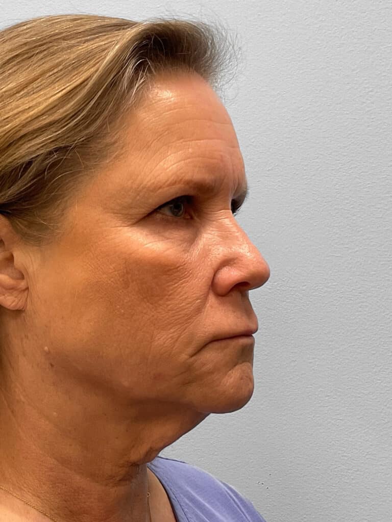 Before Image: Facelift, Browlift, & Facial Rejuvenation- Dr. Howell - right-front-oblique