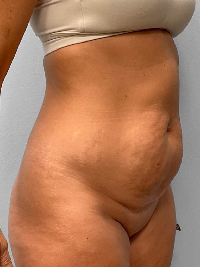 Before Image: Tummy Tuck & Liposuction- Dr. Tucker - right-front-oblique