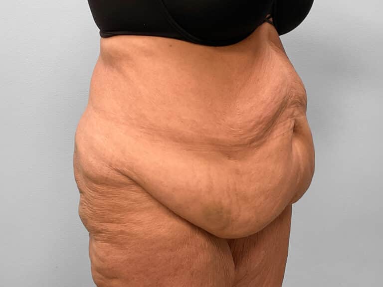 Before Image: Abdominoplasty, Lipo & Thigh Lift- Dr. Tucker - right-front-oblique
