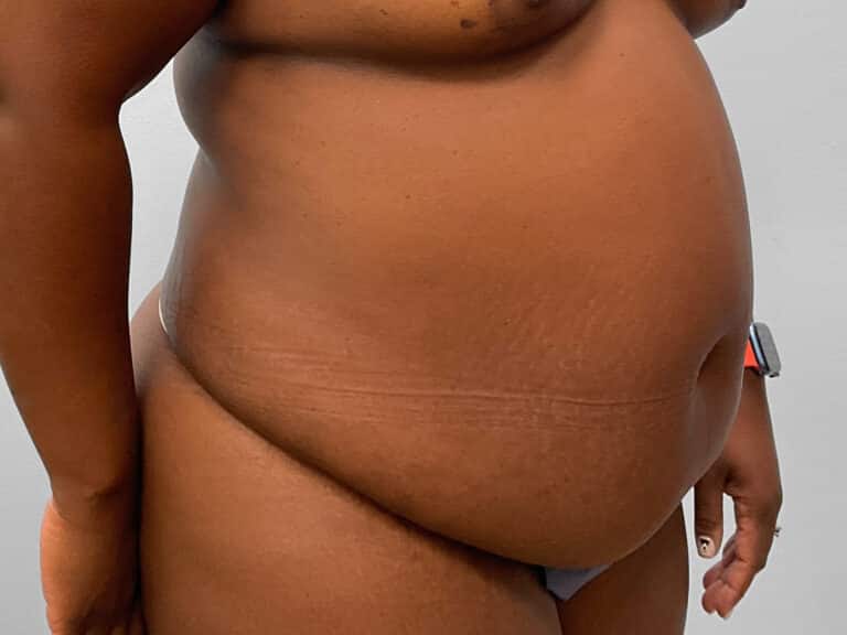 Before Image: Abdominoplasty & 360 Liposuction- Dr. Tucker - left-front-oblique