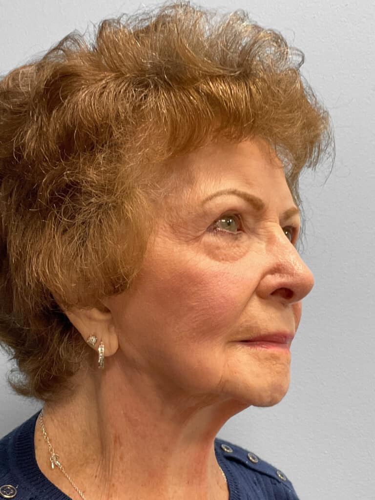 Before Image: Facelift- Dr. Tucker - right-front-oblique