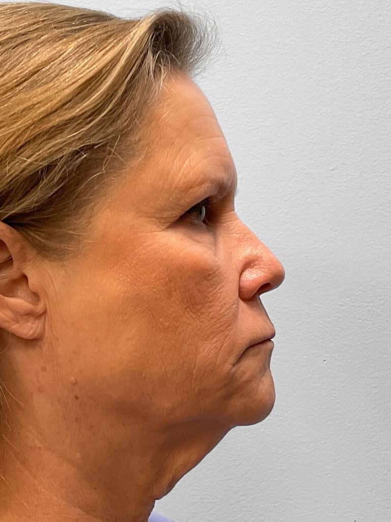 Before Image: Facelift, Browlift, & Facial Rejuvenation- Dr. Howell - right-side