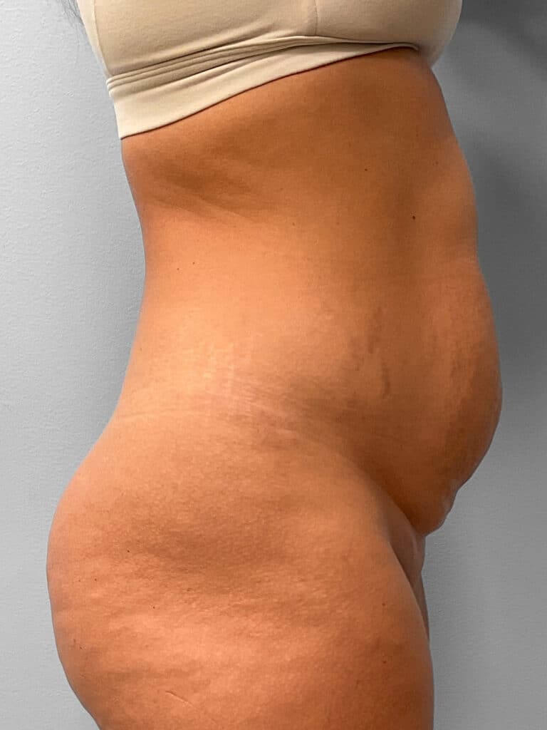 Before Image: Tummy Tuck & Liposuction- Dr. Tucker - right-side