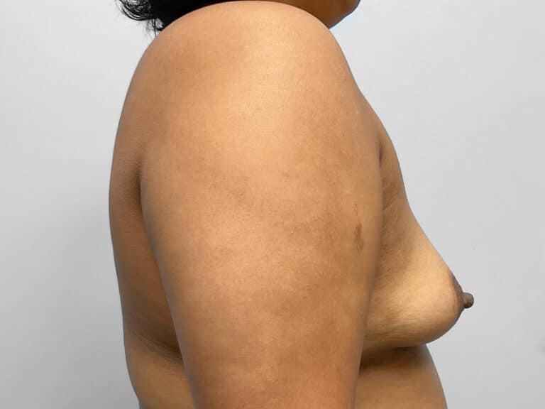Before Image: Breast Augmentation- Dr. Tucker - right-side