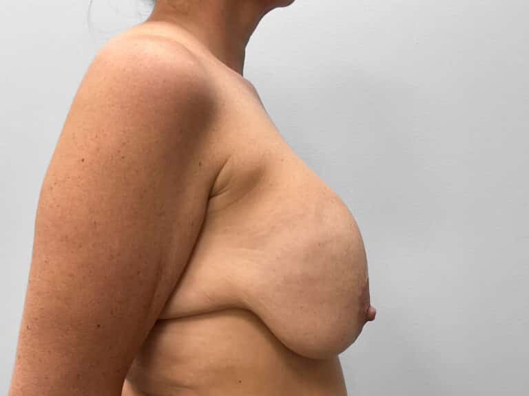 Before Image: Breast Implant Exchange- Dr. Tucker - right-side