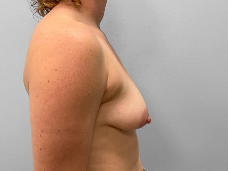 Before Image: Breast Augmentation- Dr. Tucker - right-side