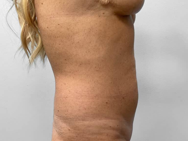 Before Image: Abdominoplasty- Dr. Tucker - right-side