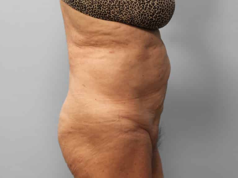 Before Image: Tummy Tuck & Lipo- Dr. Tucker - right-side
