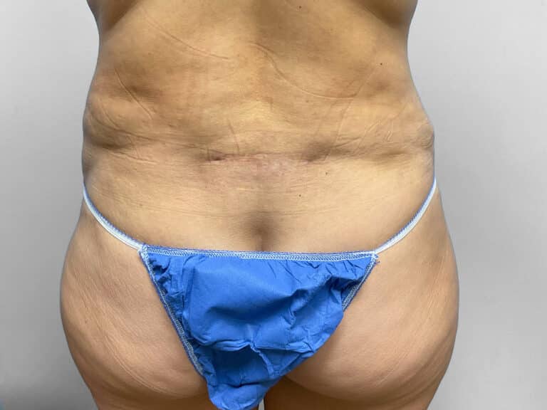 After Image: Tummy Tuck & 360 Lipo – Dr. Tucker - back