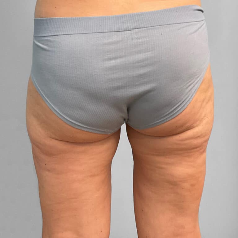 After Image: Emsculpt Neo – Jessica - back