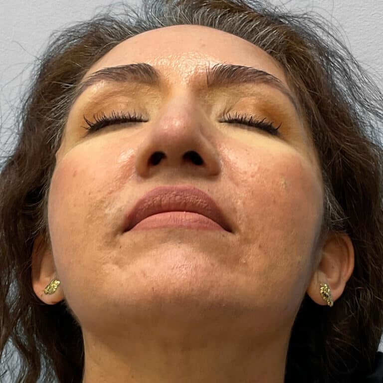 After Image: Rhinoplasty – Dr. Tucker - other