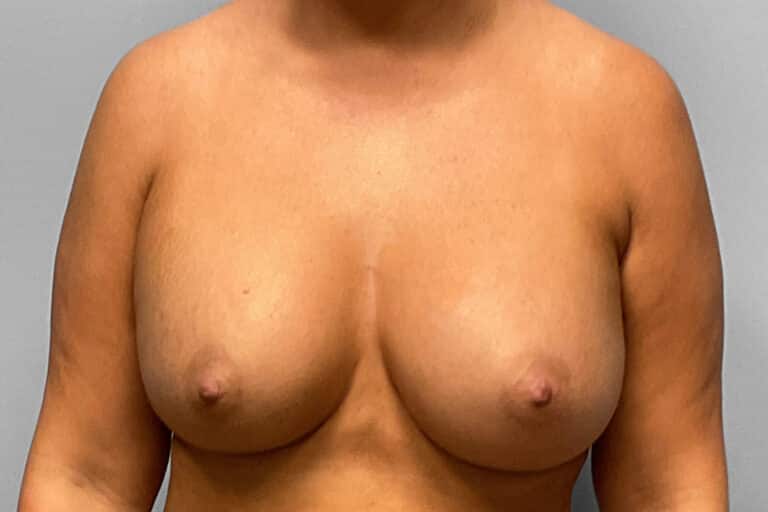 After Image: Breast Augmentation – Dr. Tucker - front