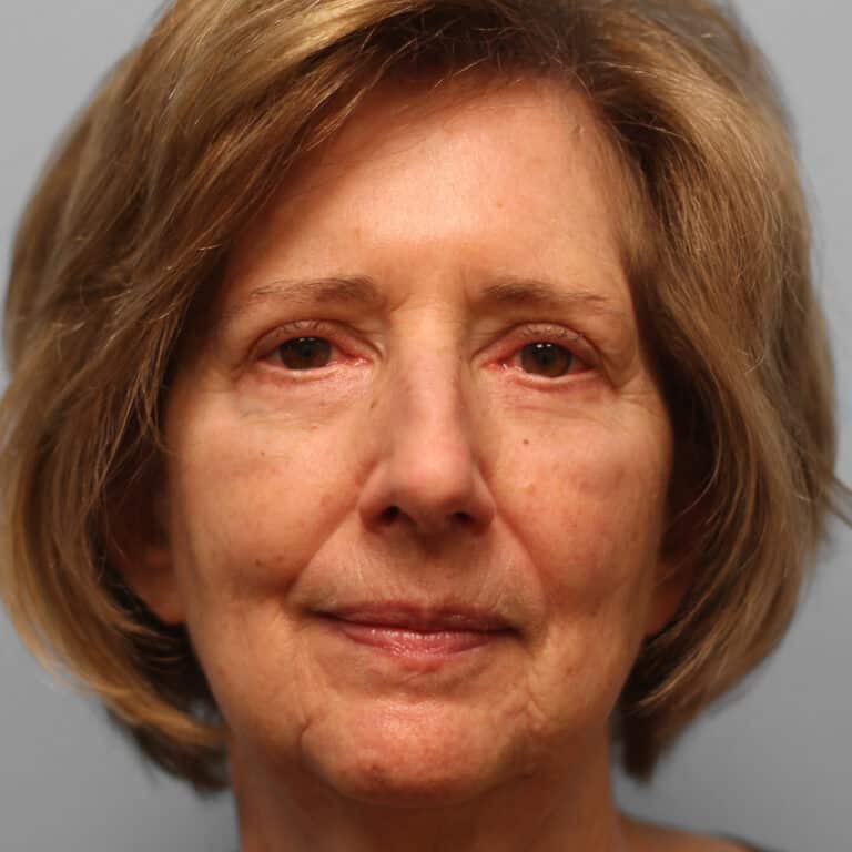 After Image: Upper & Lower Blepharoplasty – Dr. Tucker - front