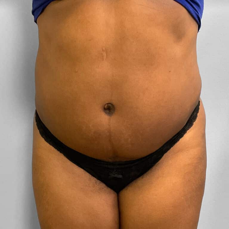 After Image: BBL, Abdominoplasty & Lipo – Dr. Tucker - front