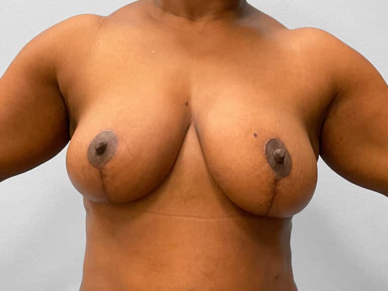 After Image: Breast Reduction – Dr. Tucker - front