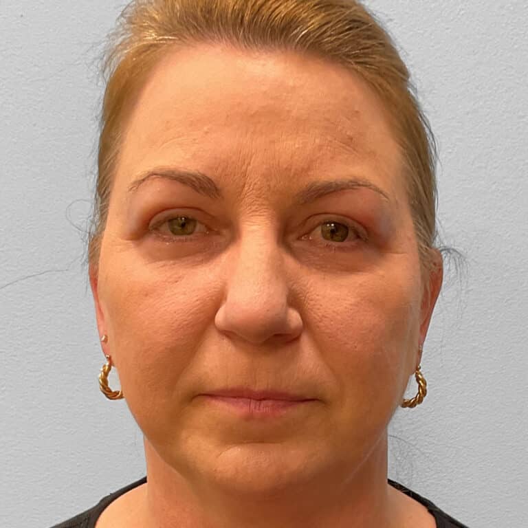 After Image: Upper and Lower Blepharoplasty – Dr. Tucker - front