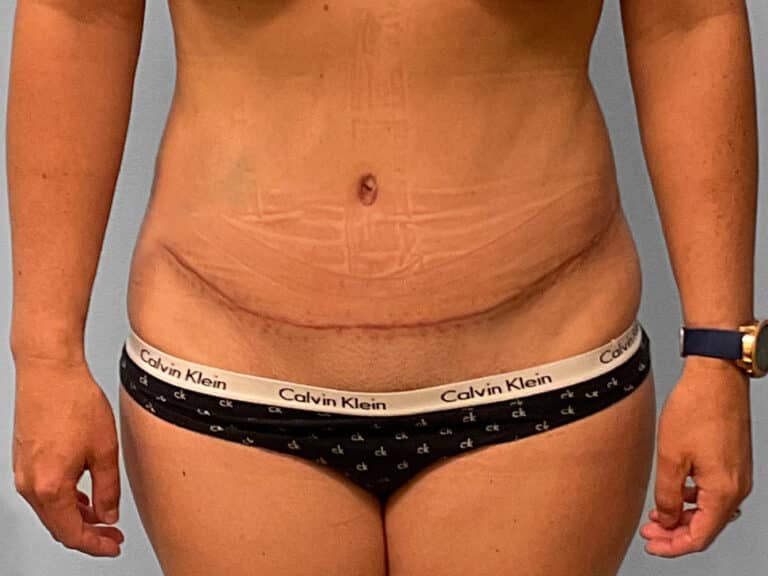 After Image: Tummy Tuck – Dr. Tucker - front
