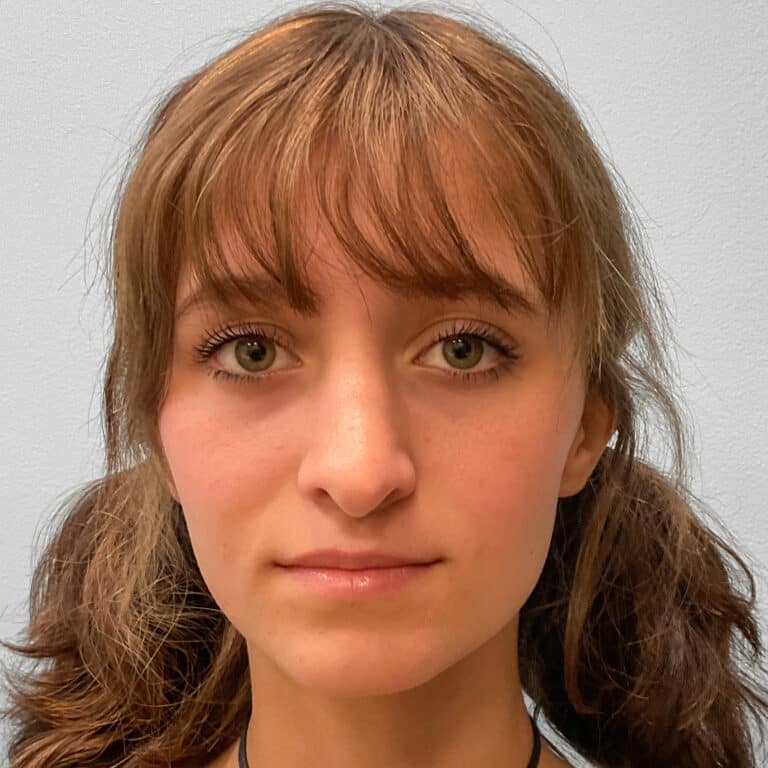 After Image: Rhinoplasty – Dr. Tucker - front