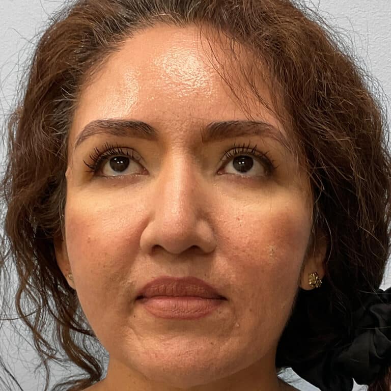 After Image: Rhinoplasty – Dr. Tucker - front