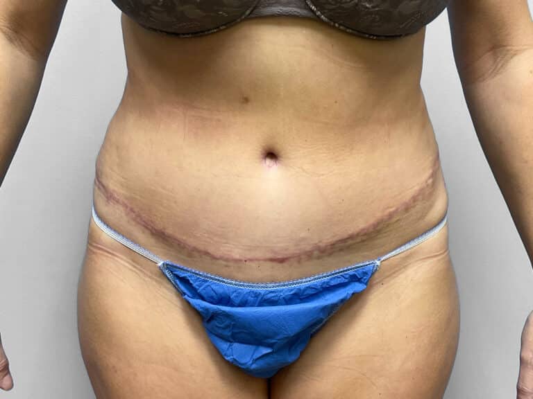 After Image: Tummy Tuck & 360 Lipo – Dr. Tucker - front