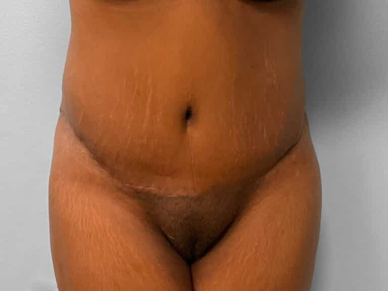 After Image: Tummy Tuck & Lipo – Dr. Tucker - front