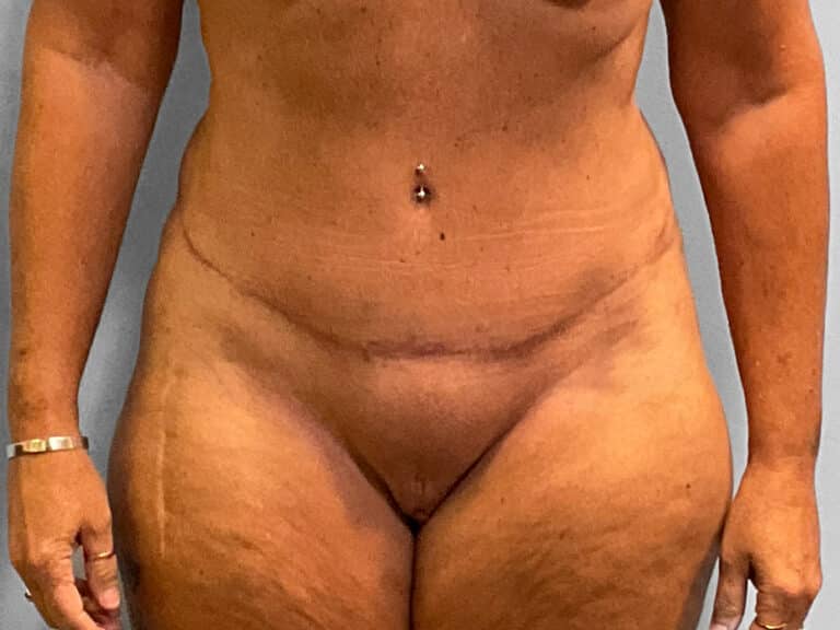 After Image: Tummy Tuck & Lipo – Dr. Tucker - front