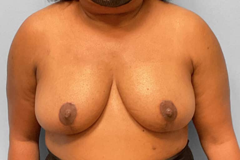 After Image: Breast Reduction – Dr. Tucker - front