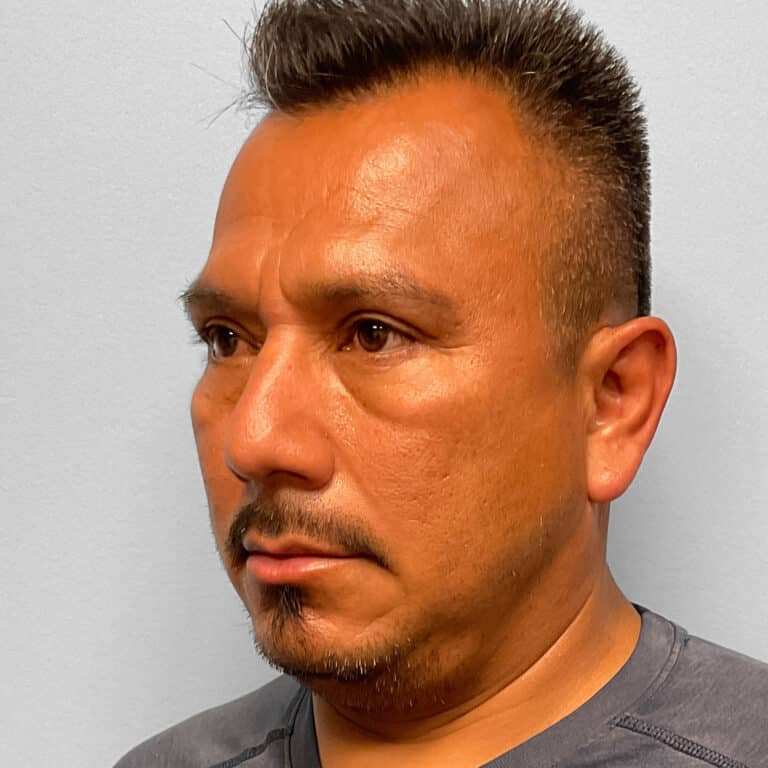 After Image: Upper & Lower Blepharoplasty – Dr. Tucker - left-front-oblique