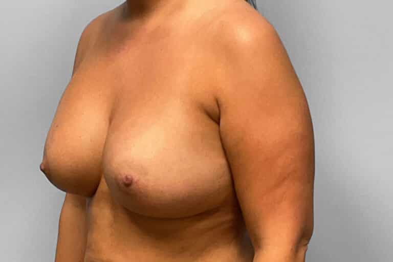 After Image: Breast Augmentation – Dr. Tucker - left-front-oblique