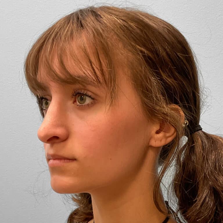 After Image: Rhinoplasty – Dr. Tucker -