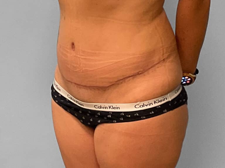 After Image: Tummy Tuck – Dr. Tucker - left-front-oblique