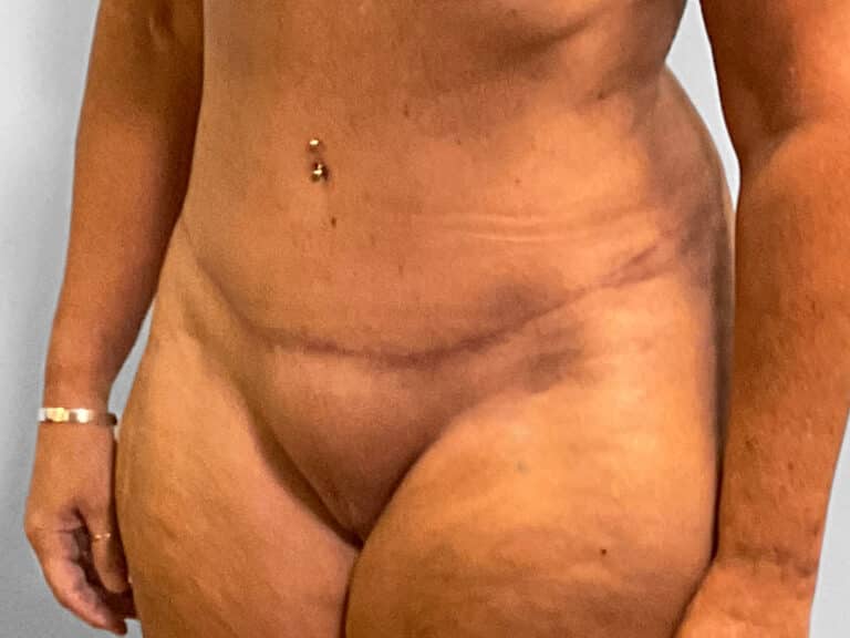 After Image: Tummy Tuck & Lipo – Dr. Tucker - left-front-oblique