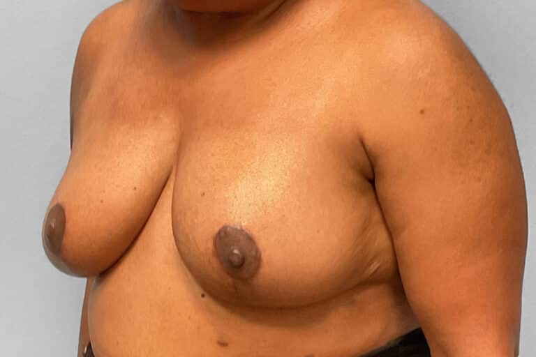 After Image: Breast Reduction – Dr. Tucker - left-front-oblique