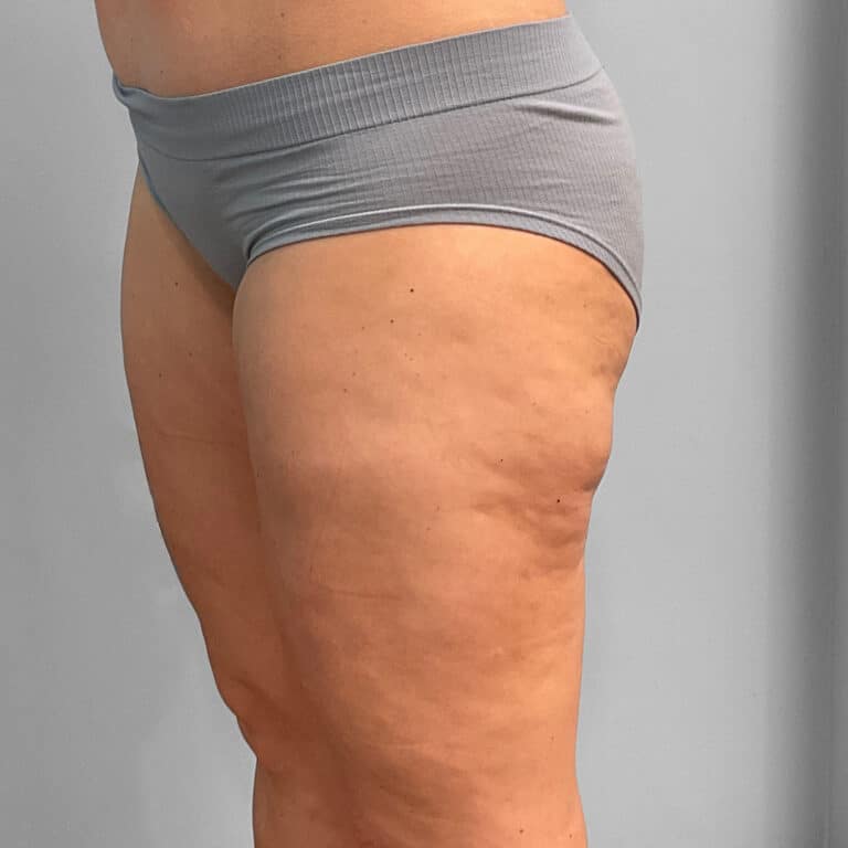 After Image: Emsculpt Neo – Jessica - left-front-oblique