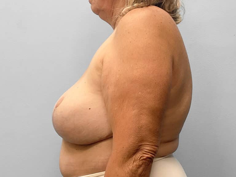 After Image: Breast Lift & Implant Removal – Dr. Tucker - left-side
