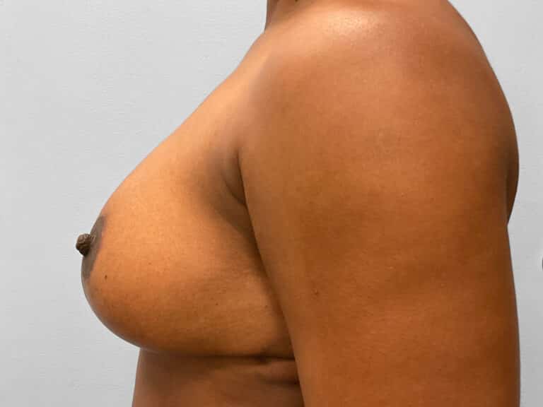 After Image: Breast Reduction – Dr. Tucker - left-side
