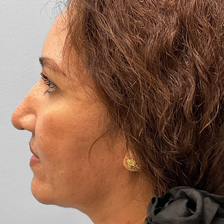 After Image: Rhinoplasty – Dr. Tucker - left-side