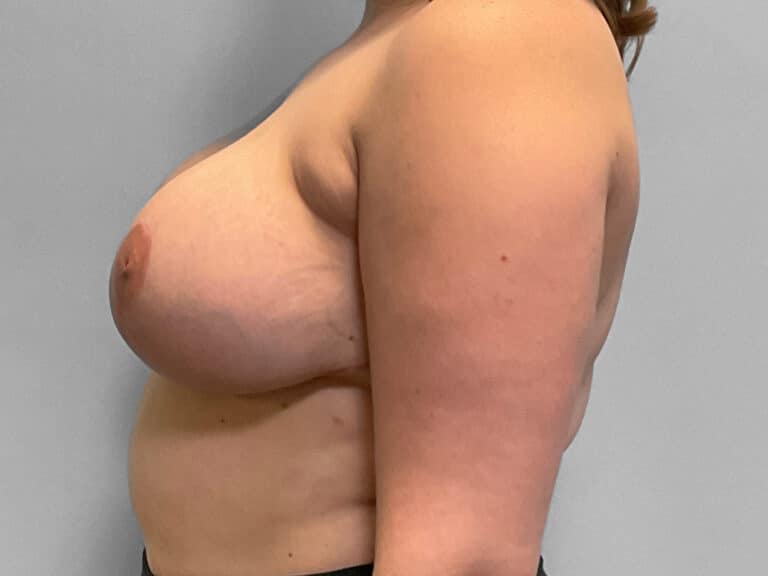 After Image: Breast Reduction – Dr. Tucker - left-side