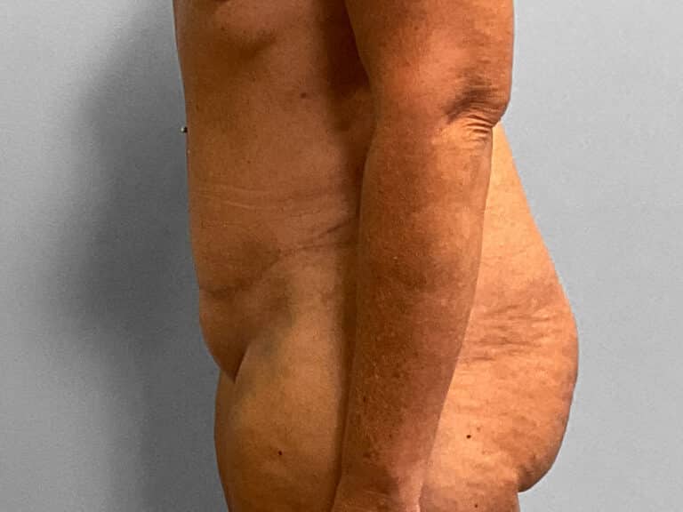 After Image: Tummy Tuck & Lipo – Dr. Tucker - left-side