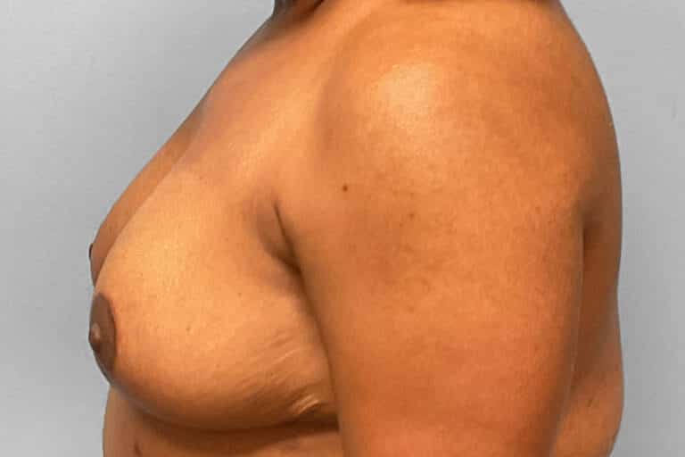 After Image: Breast Reduction – Dr. Tucker - left-side