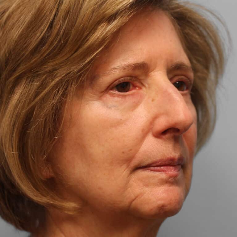After Image: Upper & Lower Blepharoplasty – Dr. Tucker - right-front-oblique
