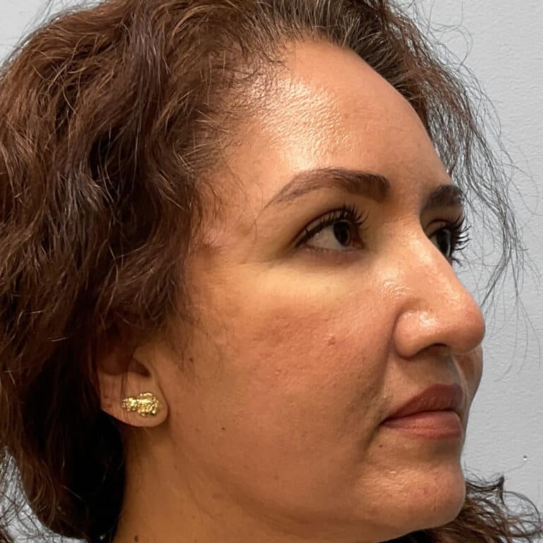 After Image: Rhinoplasty – Dr. Tucker - right-front-oblique
