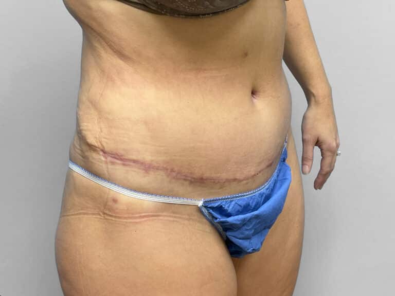 After Image: Tummy Tuck & 360 Lipo – Dr. Tucker - right-front-oblique