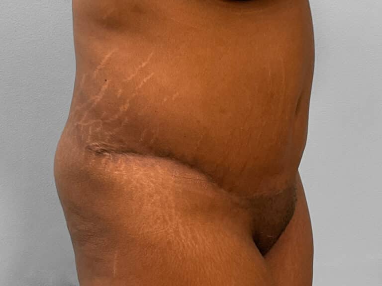 After Image: Tummy Tuck & Lipo – Dr. Tucker - right-front-oblique